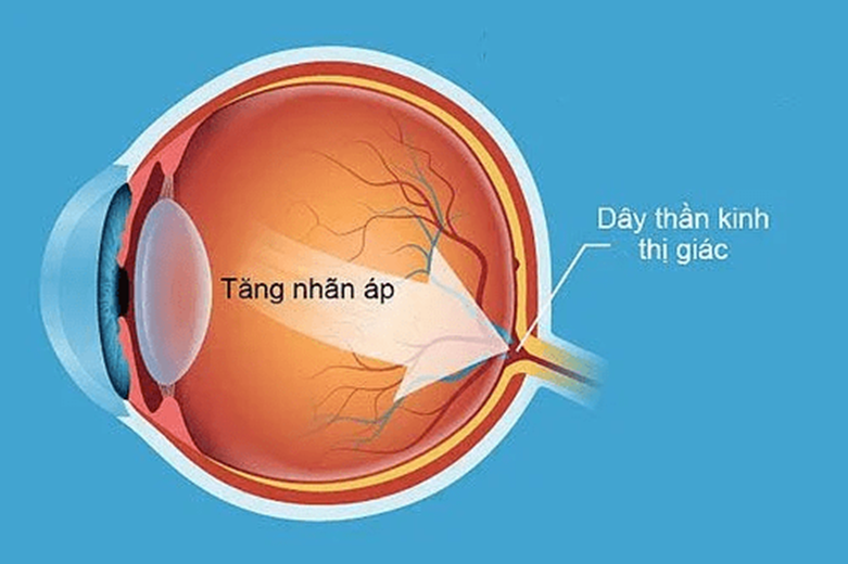 Bệnh Glocôm: Nguyên nhân, triệu chứng, chẩn đoán và phòng tránh